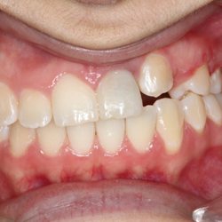 Implantasmile - Before