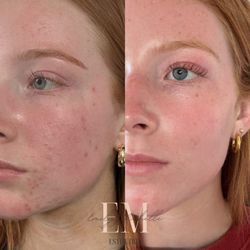 Acne Bootcamp