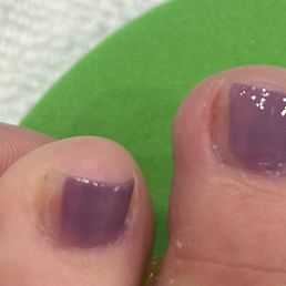 Poor pedicure.