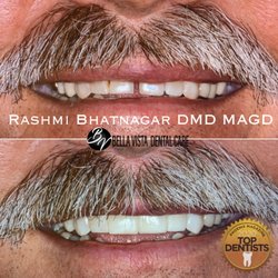 Dentique by Dr. B - Cosmetic Bonding Smile Makeover by Dr. Bhatnagar