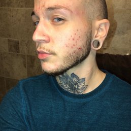 Rash