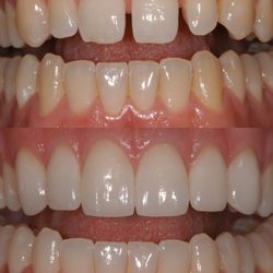 Feel Good Dental - Veneers