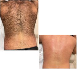 Keis To Beauty - Full Back Waxing!