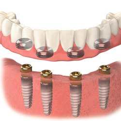 Affordable Dentures Tacoma Washington  . With More Than 280 Affiliated Practices In 40 States, We Likely Have A Practice Close To You!