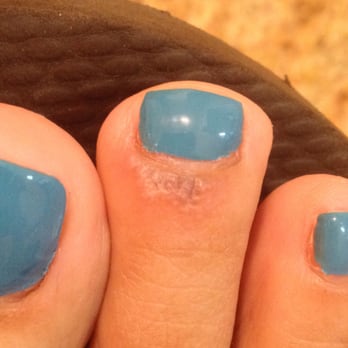 Bebe Nails & Spa - Skin damaged from BEBE Nails & Spa (day after pedicure) - Nail Salons Near Me - Oakland, California