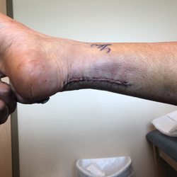 Advanced Orthopedic & Sports Medicine Specialists, PC - Post surgery. Clean work.  No infection.