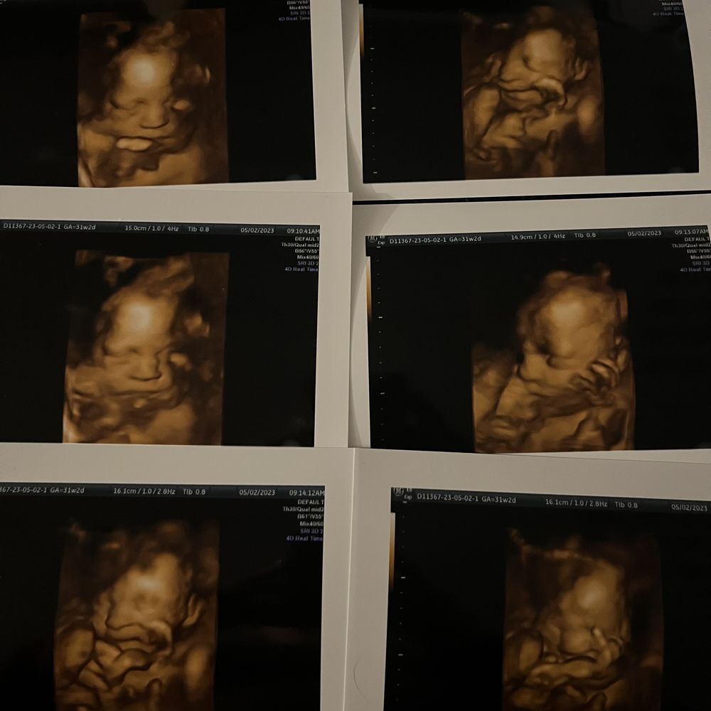 23 Weeks 3d Ultrasound