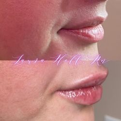 The Aesthetics Boutique - Natural Lip Filler Results