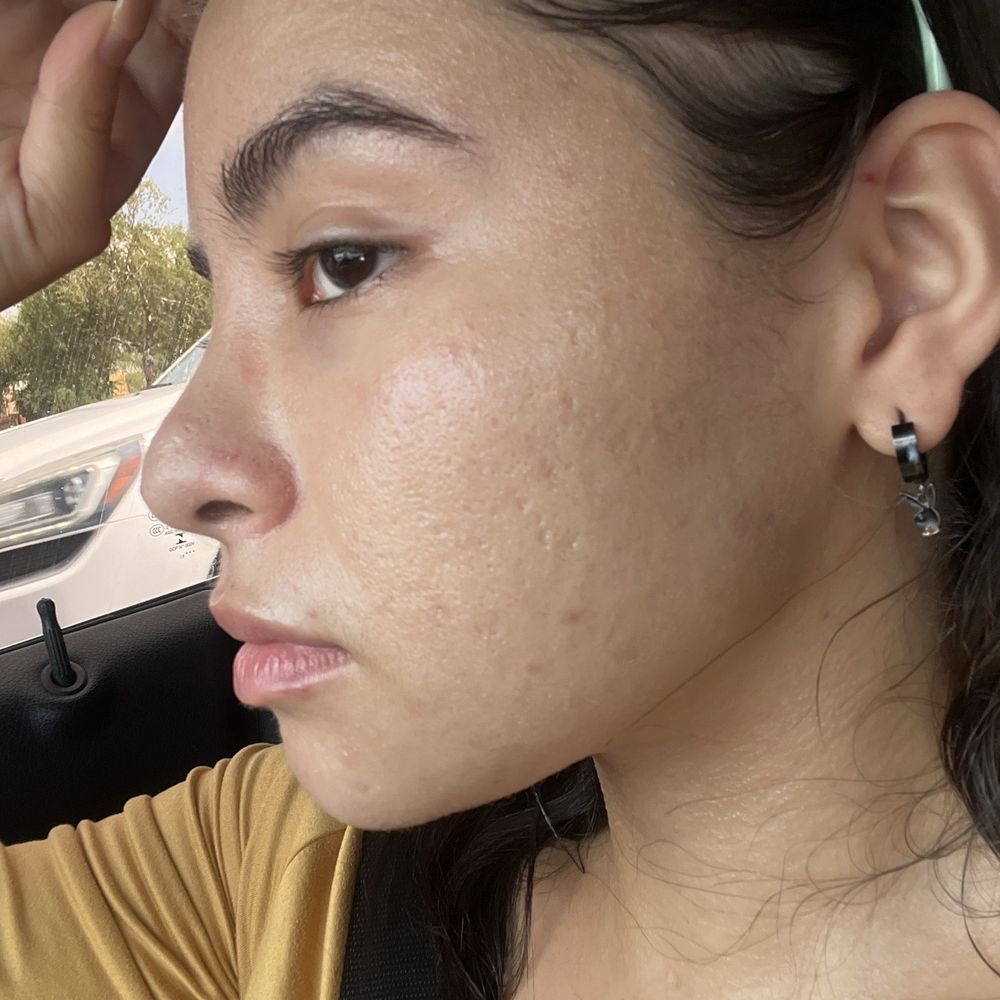 Dolce Lounge Aesthetics Wellness - My face immediately after - Medical Spas Near Me - Chandler, Arizona Dolce Lounge Aesthetics Wellness - My face immediately after - Medical Spas Near Me - Chandler, Arizona