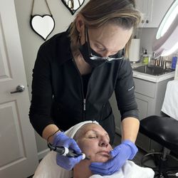 Natalia, Microneedling