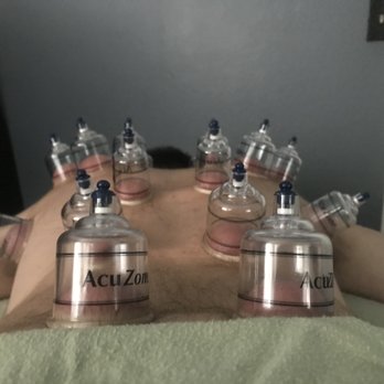 Massage by Eve - Cupping - Massage Therapy Near Me Massage by Eve - Cupping - Massage Therapy Near Me