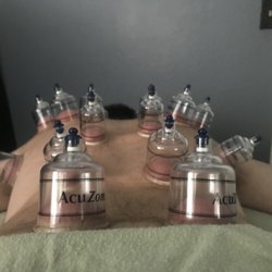 Massage by Eve - Cupping