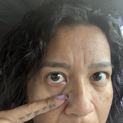 Belaray Dermatology PC - After removed