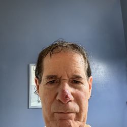 Eduardo Weiss - DR. Eduardo Weiss performed what he said was a simple Mohs surgery on my nose but he couldn't close the wound properly! 8 days falling out!