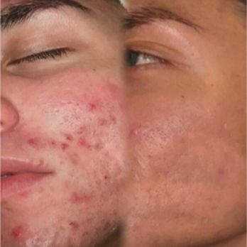 re:fresh skin + injectables - Dermalinfusion Treatment - Skin Care Near Me - Valhalla, New York re:fresh skin + injectables - Dermalinfusion Treatment - Skin Care Near Me - Valhalla, New York