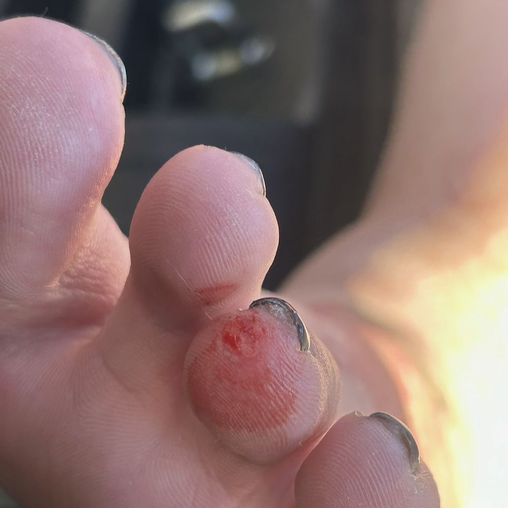 Nails Pro Spa - My toe that was hurt. - Nail Salons Near Me - Edgewater, Colorado Nails Pro Spa - My toe that was hurt. - Nail Salons Near Me - Edgewater, Colorado
