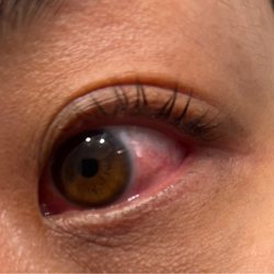 My Brows - Very itchy and infection