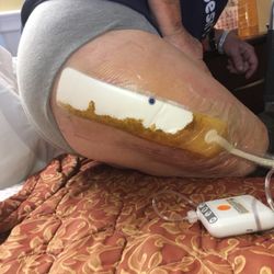 Nicholas H. Mast, MD - That's how I left the hospital and was sent to rehab. That orange color is not antiseptic it is body fluid.
