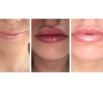 Dolce Aesthetics - Botox, Lip injection, Juvederm, Jaw Cheek Contouring, Non surgical nose jobs, Laser facials, Kybella, Voluma, Microneedling, Chemical peel - Medical Spas Near Me - Glendale, New York