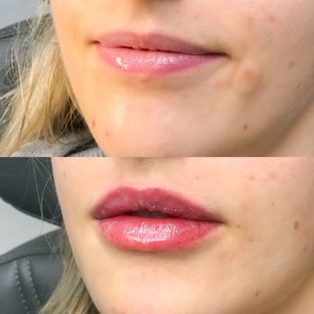 Studio R Aesthetics - Restylane Kysse Lip Filler - Medical Spas Near Me - Charlottesville, Virginia