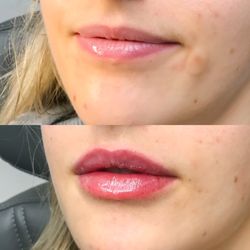 Studio R Aesthetics - Restylane Kysse Lip Filler