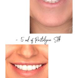 Cosmetic Med Solutions - Restalyne Silk