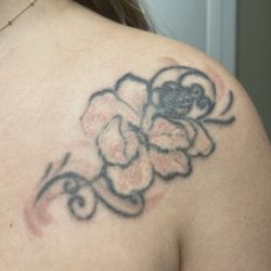 Bad Ink Laser Clinic - After my first session (it just felt like a sunburn!)