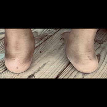 Ortho Carolina - Side by side my feet now - Podiatrists Near Me - Belmont, North Carolina Ortho Carolina - Side by side my feet now - Podiatrists Near Me - Belmont, North Carolina