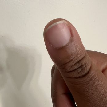 Ivy Nails - Example of nail damage almost growed out after Wendy burned through nail bed with e-file. - Nail Salons Near Me - Alexandria, Virginia