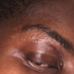 My eyebrow with cuts and it just as bad on the other eye.