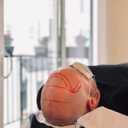 SMP Hair Vancouver  - SMP HAIRLINE