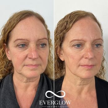 EverGlow Aesthetics - Facial rejuvenation with fillers in the undereyes, cheeks, jawline, chin shadows, and lips - Medical Spas Near Me - Tustin, California