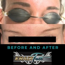EradiTatt Tattoo Removal of St. Petersburg