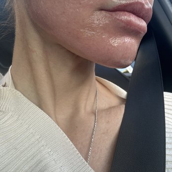 XS MedSpa - Fontana laser after 1 hour. - Medical Spas Near Me - Fort Lauderdale, Florida XS MedSpa - Fontana laser after 1 hour. - Medical Spas Near Me - Fort Lauderdale, Florida