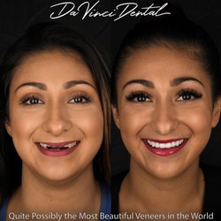 Da Vinci Dental - Words can't explain the impact this new smile will have on her life. She can now explode with confidence when she smiles, speaks and laughs!