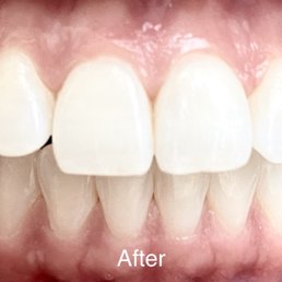 After Invisalign After Invisalign
