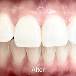 La Costa Orthodontics - After Invisalign