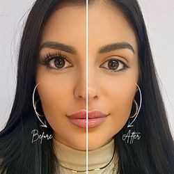 Lifting effect