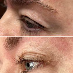 Nüskin Facial Spa - Before and after upper eyelid plasma pen treatment with dramatic results