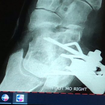 Walmart Supercenter - an x - ray of a broken tooth - Grocery Near Me - Harrisville, Utah Walmart Supercenter - an x - ray of a broken tooth - Grocery Near Me - Harrisville, Utah
