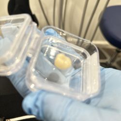 Conshohocken Dental Care - My new cap/tooth replacement!