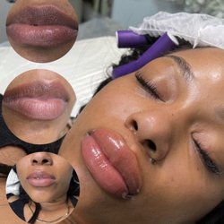 TheGlowFacial - Lip neutralization