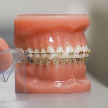Nova Orthodontics - Example of Metal Braces. Nova is the best place to get braces in Mill Creek - Orthodontists Near Me - Mill Creek, Washington Nova Orthodontics - Example of Metal Braces. Nova is the best place to get braces in Mill Creek - Orthodontists Near Me - Mill Creek, Washington