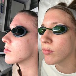 Face Five Acne Clinic