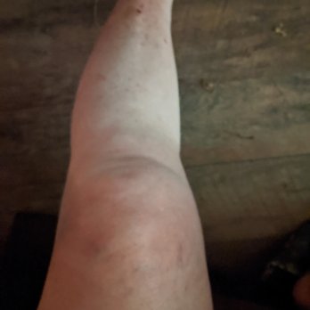 Quest Diagnostics - Left arm bruising right arm looks similar. - Laboratory Testing Near Me - Little Rock, Arkansas