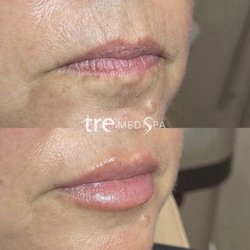 Tre MedSpa - Lip filler