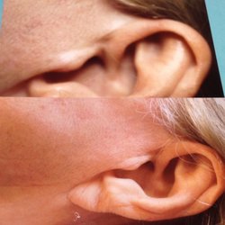 Permanent Make-Up Clinic - Face lift scars