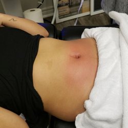 Renouvele Body Solutions - After Cryo Slimming Treatment Session #1. Inch loss measured at 1.5 inches in 28 minutes.