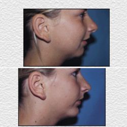 Aesthetic and Cosmetic Plastic Surgery Center - Chin Definition with a chin implant