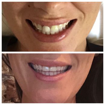 New Day Dentistry Centennial | Dr. Amanda Hudec, DMD - Before top/ After Bottom - General Dentistry Near Me - Centennial, Colorado New Day Dentistry Centennial | Dr. Amanda Hudec, DMD - Before top/ After Bottom - General Dentistry Near Me - Centennial, Colorado